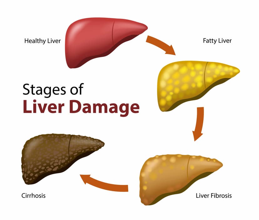 Causes of Fatty Liver and Its Treatment